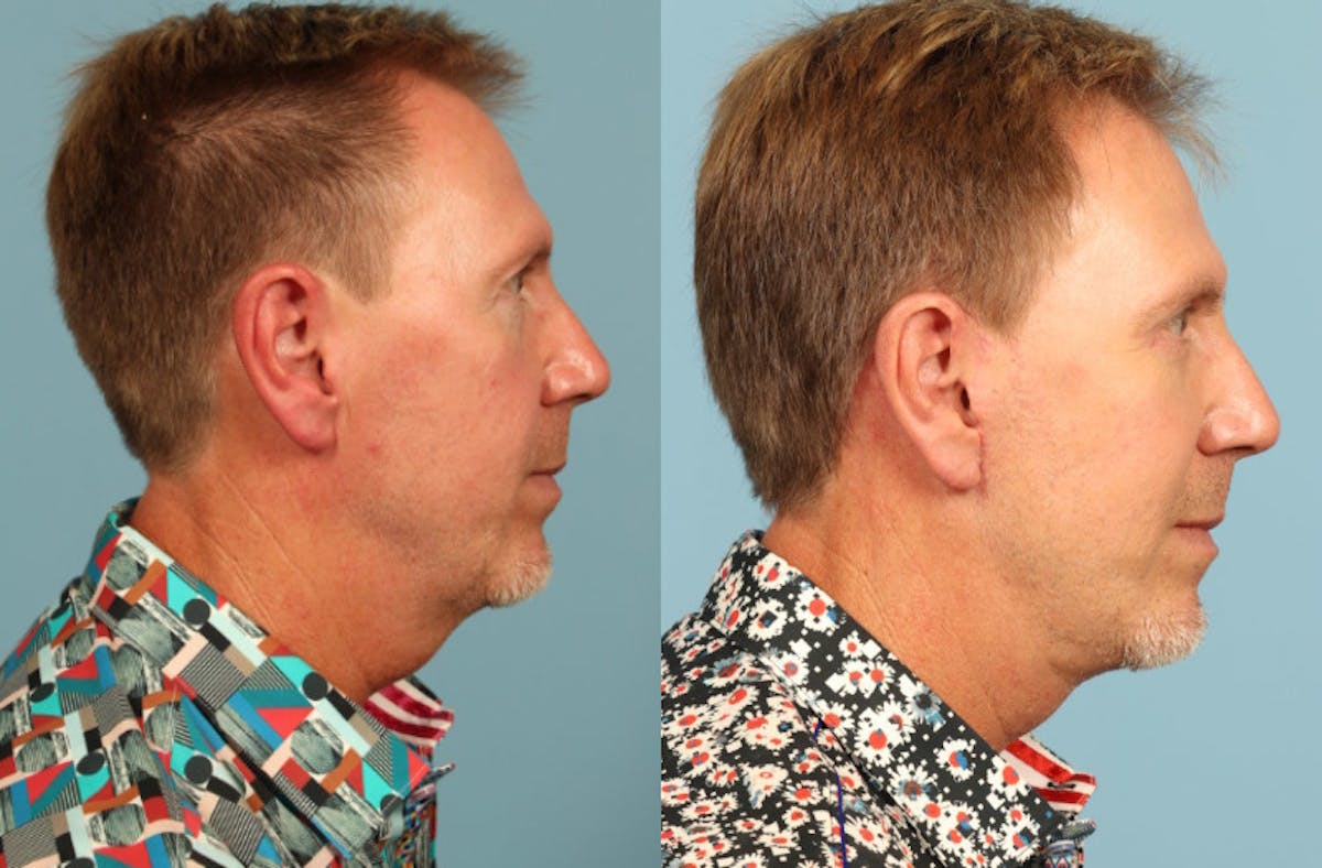 Facelift Before & After Gallery - Patient 394649 - Image 3