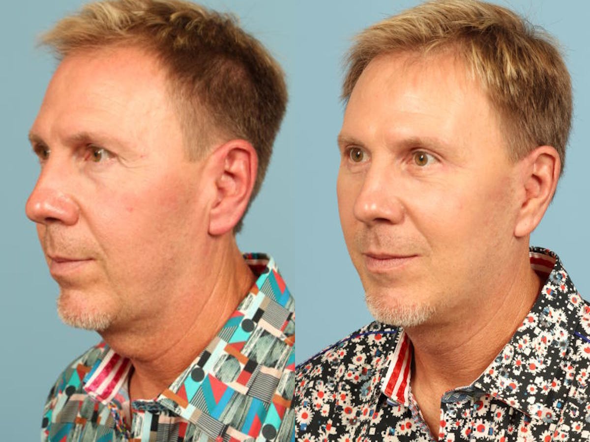 Facelift Before & After Gallery - Patient 394649 - Image 4