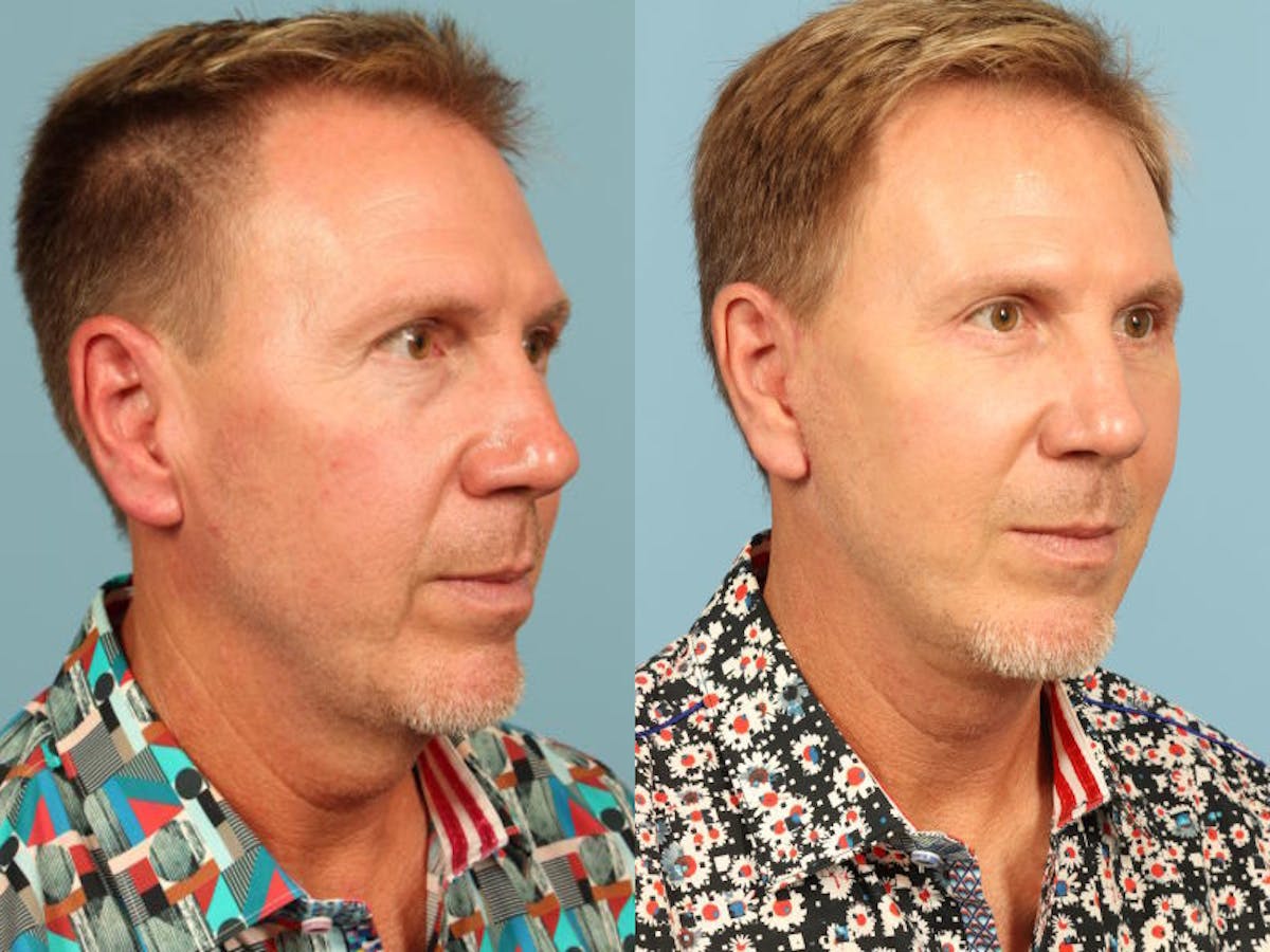 Facelift Before & After Gallery - Patient 394649 - Image 5