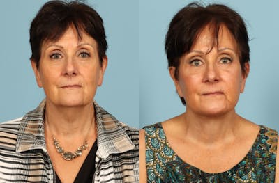 Facelift Before & After Gallery - Patient 357393 - Image 1