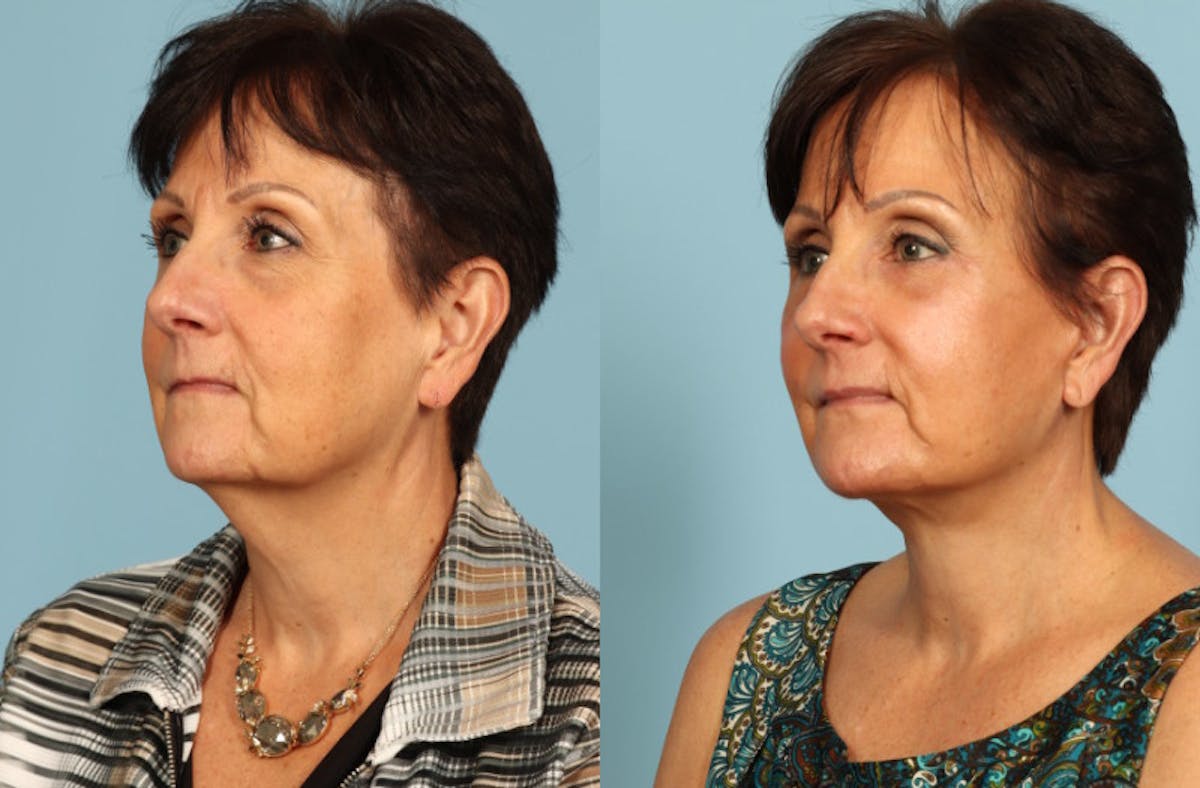 Facelift Before & After Gallery - Patient 357393 - Image 2