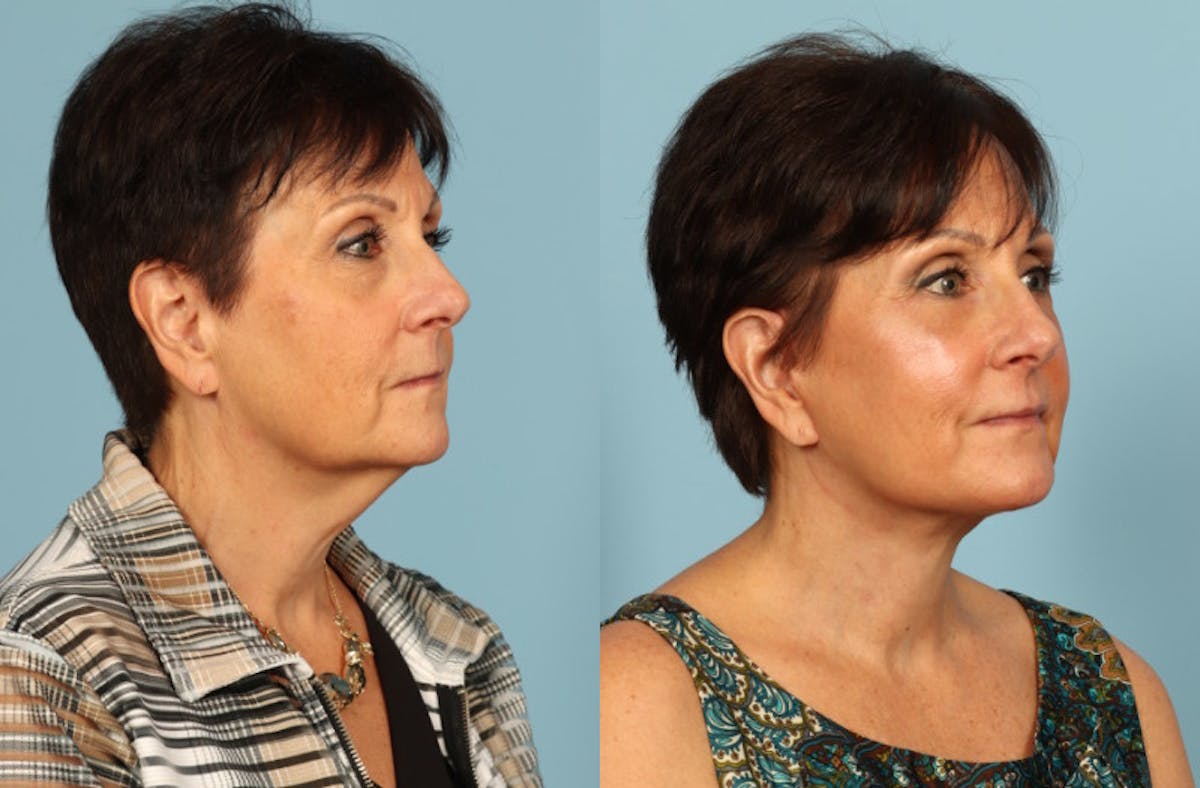 Facelift Before & After Gallery - Patient 357393 - Image 3