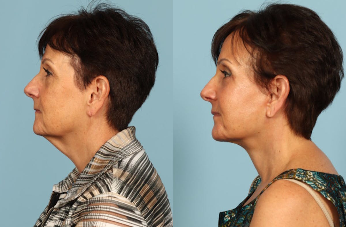 Facelift Before & After Gallery - Patient 357393 - Image 4
