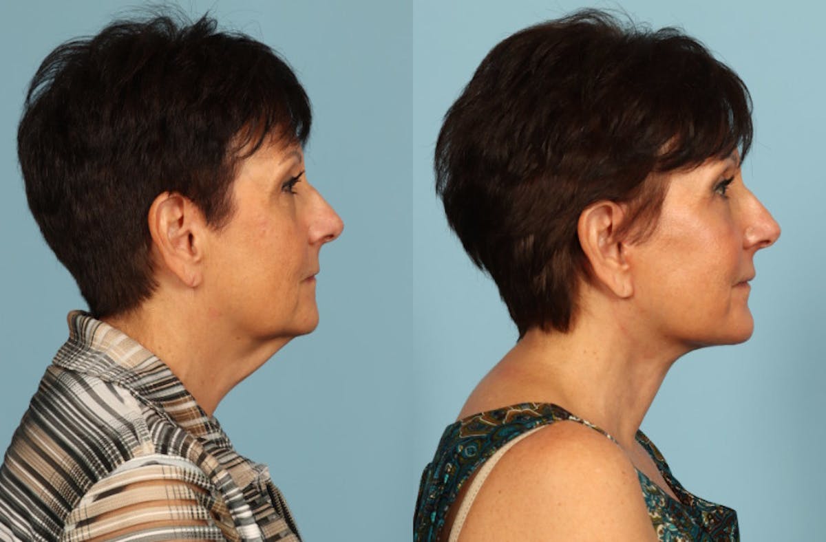 Facelift Before & After Gallery - Patient 357393 - Image 5