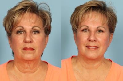 Facelift Before & After Gallery - Patient 108914 - Image 1