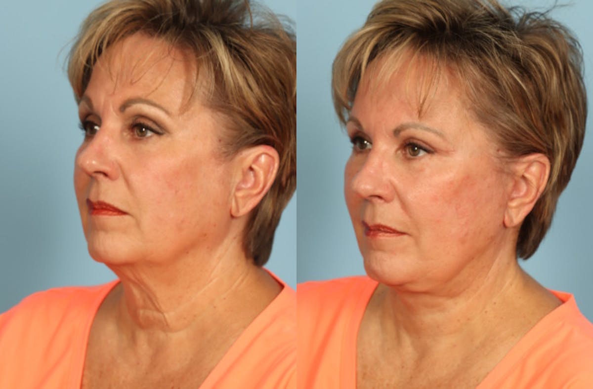 Facelift Before & After Gallery - Patient 108914 - Image 2