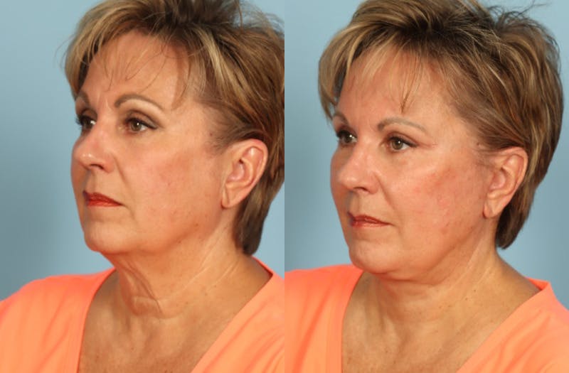 Facial Fat Grafting Before & After Gallery - Patient 212445 - Image 2