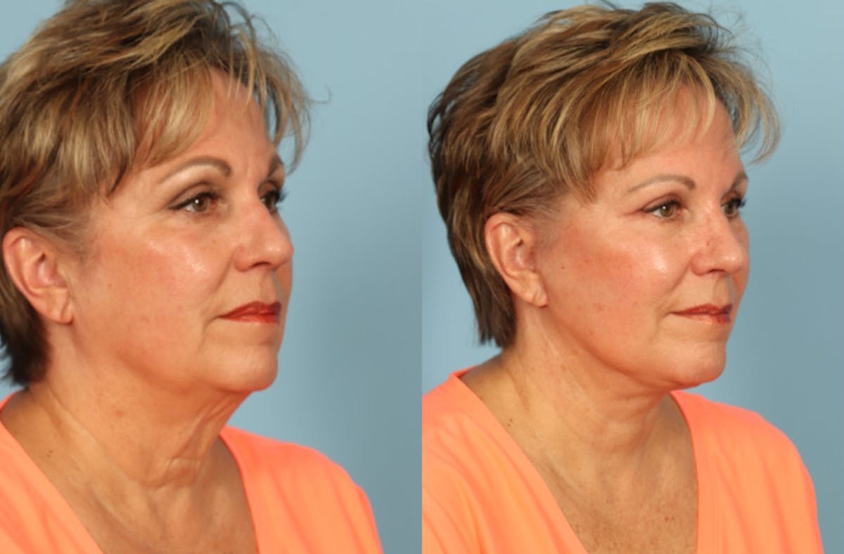 Facelift Before & After Gallery - Patient 108914 - Image 3