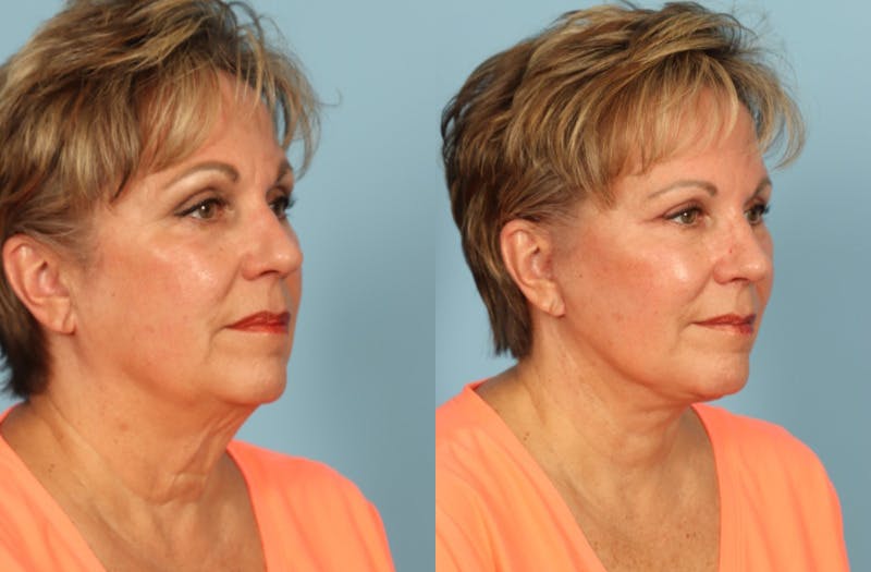 Facial Fat Grafting Before & After Gallery - Patient 212445 - Image 3