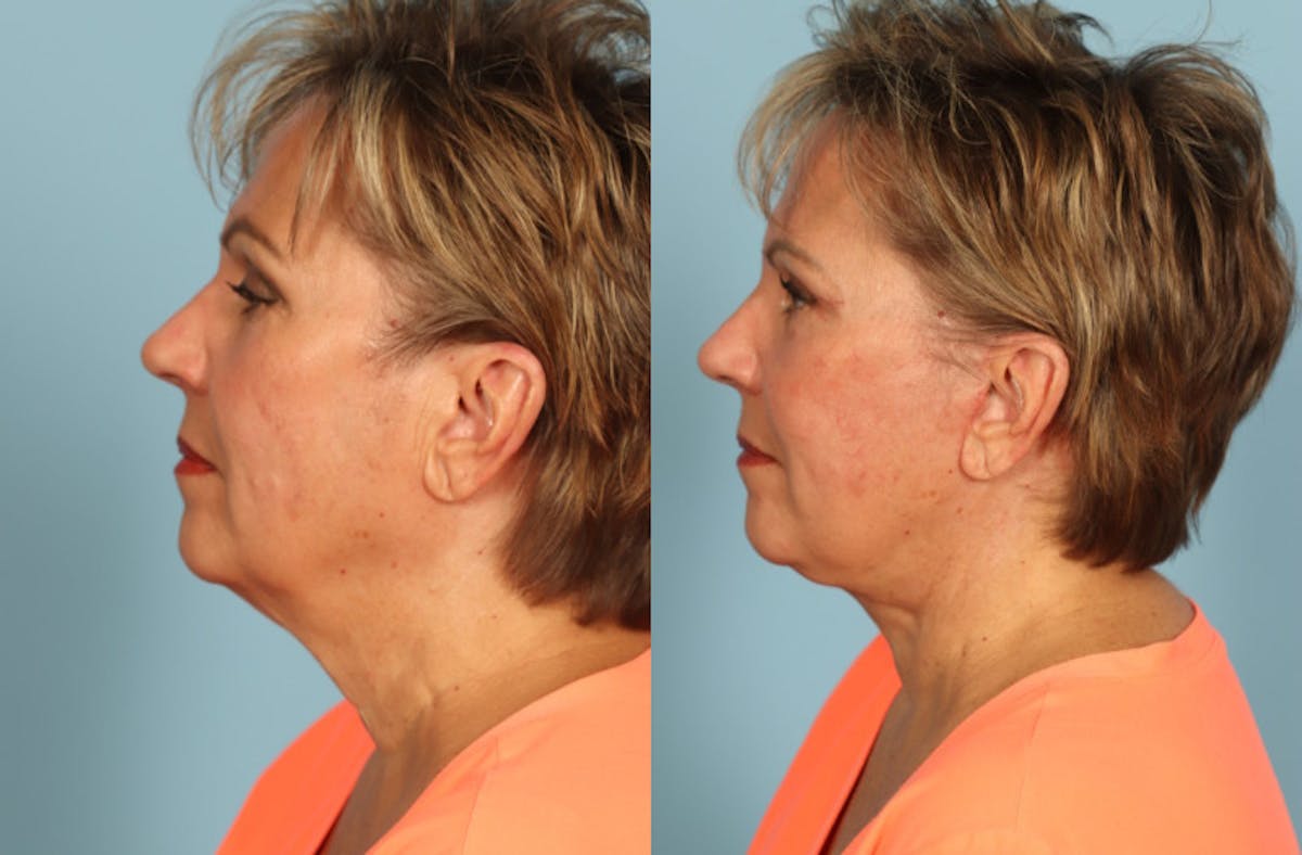 Facelift Before & After Gallery - Patient 108914 - Image 4