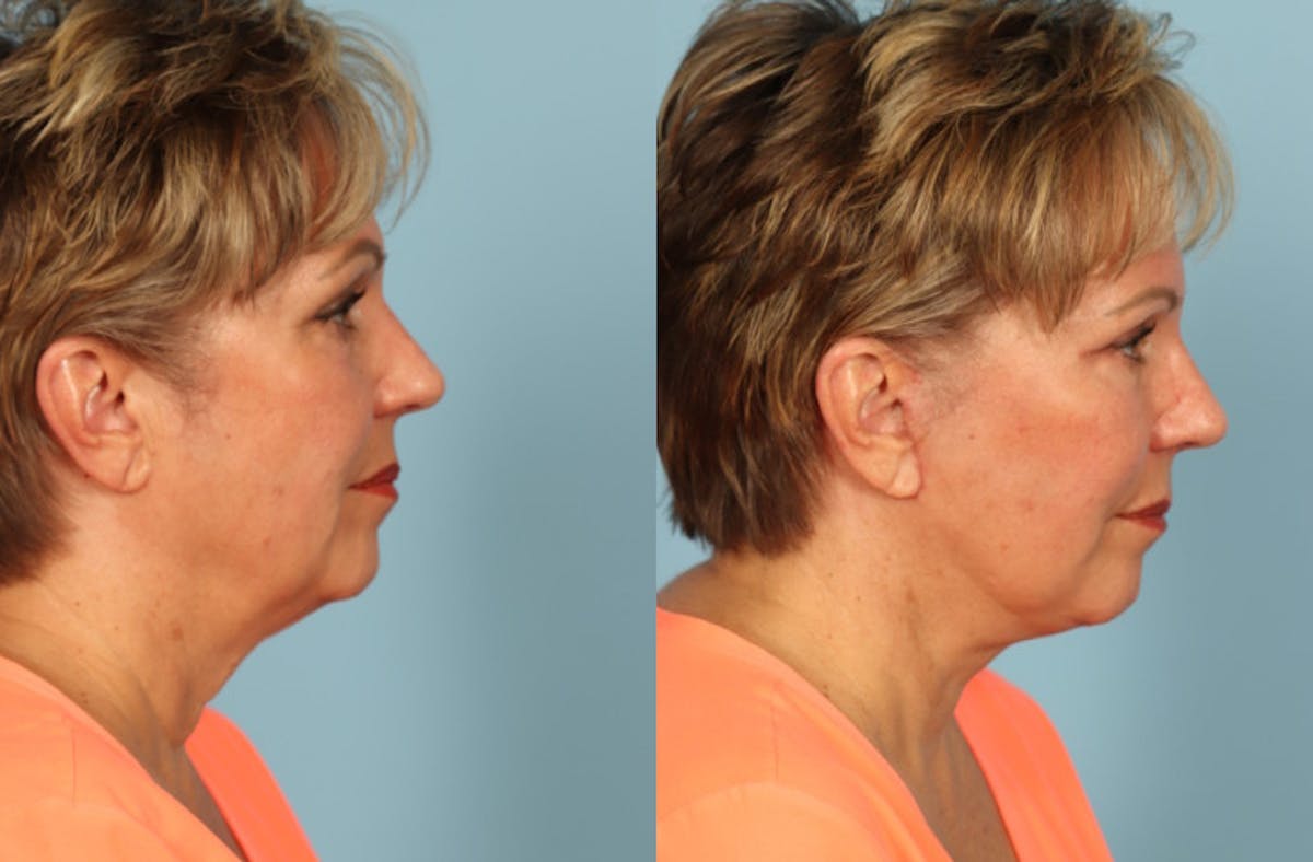 Facelift Before & After Gallery - Patient 108914 - Image 5
