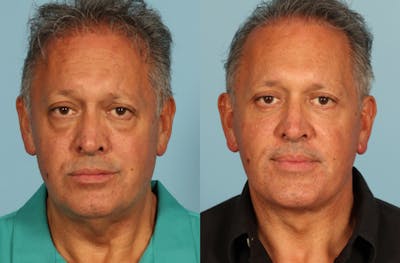 Facelift Before & After Gallery - Patient 708334 - Image 1