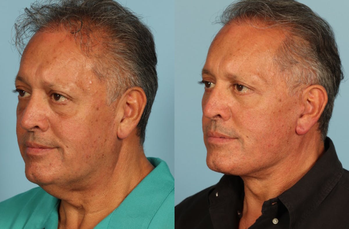 Facelift Before & After Gallery - Patient 708334 - Image 2