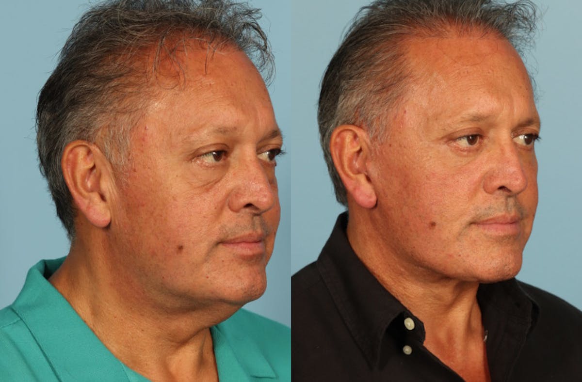 Facelift Before & After Gallery - Patient 708334 - Image 3