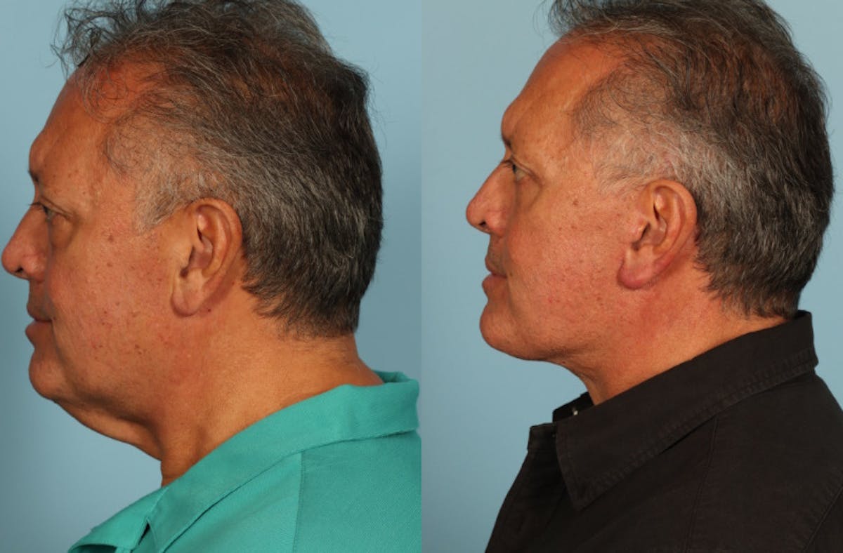 Facelift Before & After Gallery - Patient 708334 - Image 4