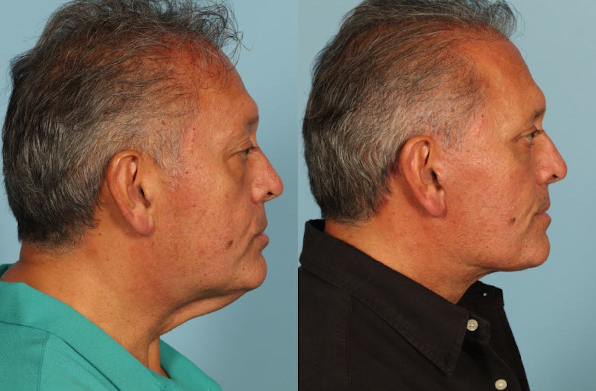 Facelift Before & After Gallery - Patient 708334 - Image 5