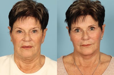 Facelift Before & After Gallery - Patient 357656 - Image 1