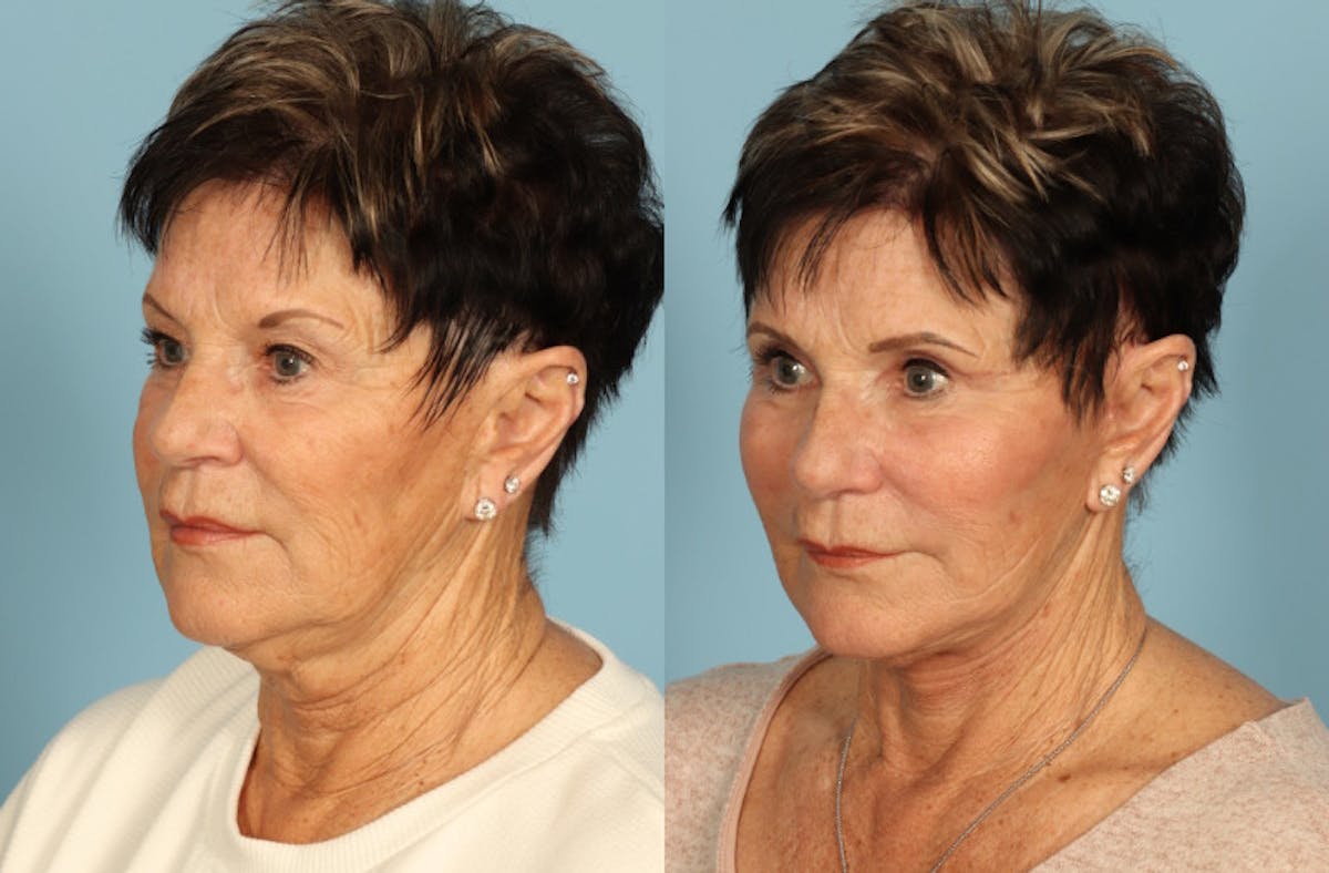Facelift Before & After Gallery - Patient 357656 - Image 2