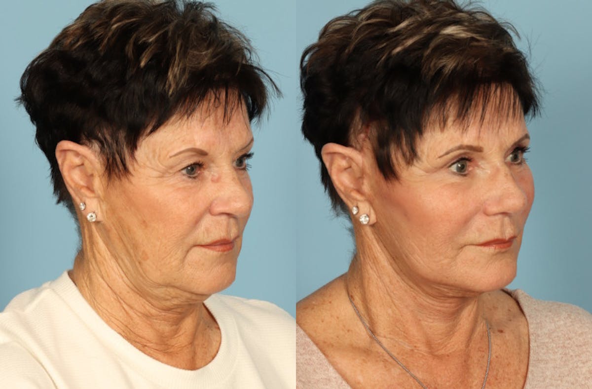 Facelift Before & After Gallery - Patient 357656 - Image 3