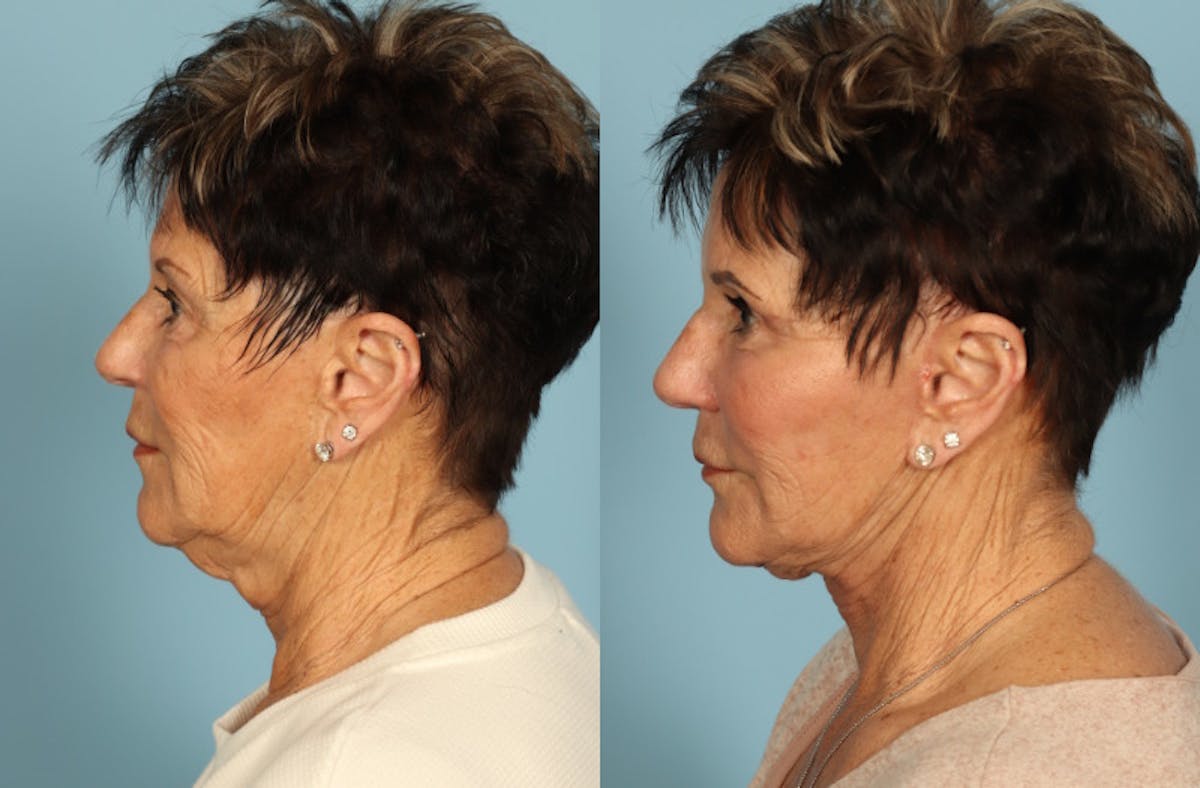 Facelift Before & After Gallery - Patient 357656 - Image 4