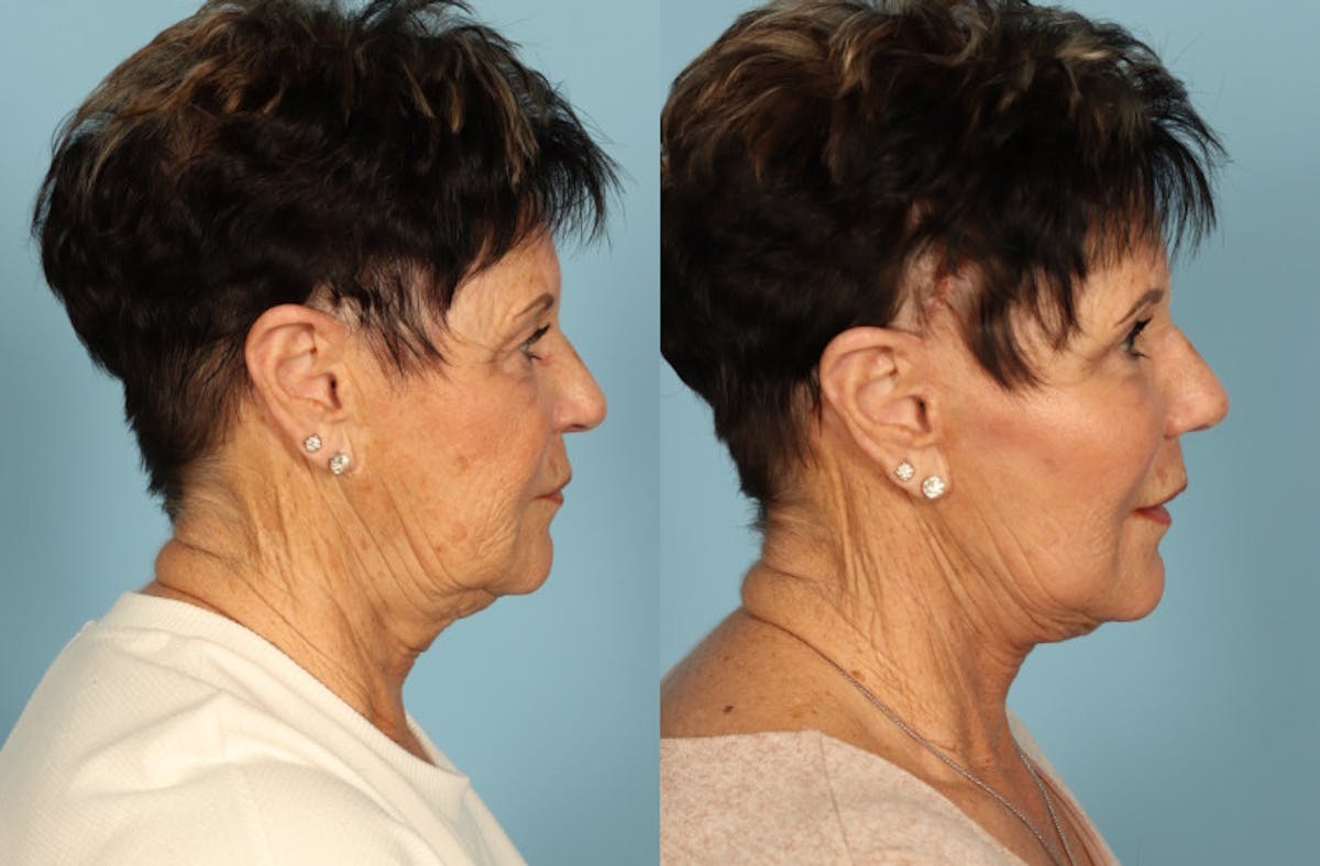 Facelift Before & After Gallery - Patient 357656 - Image 5