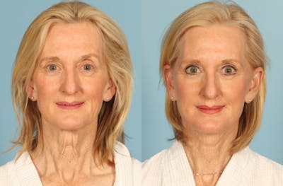 Facelift Before & After Gallery - Patient 677302 - Image 1