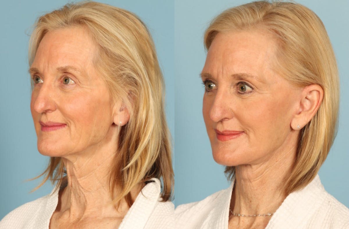 Facelift Before & After Gallery - Patient 677302 - Image 2