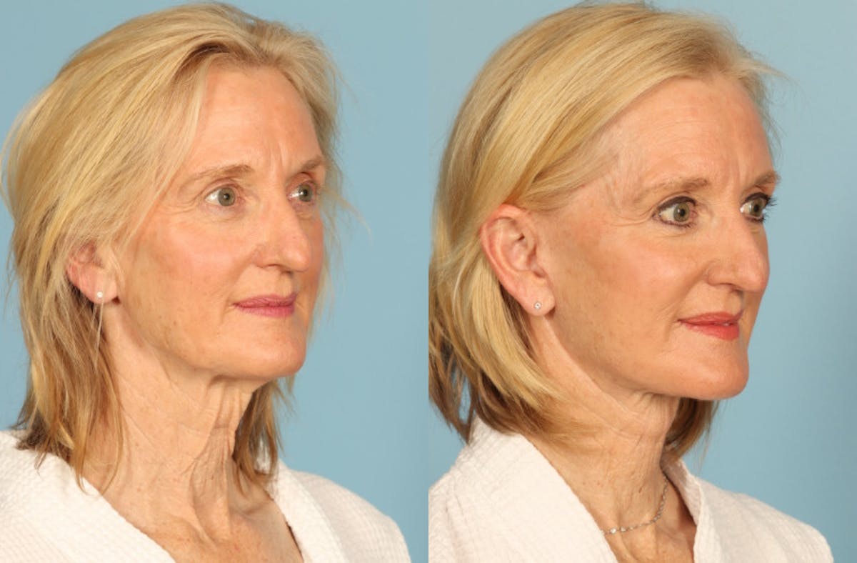Facelift Before & After Gallery - Patient 677302 - Image 3