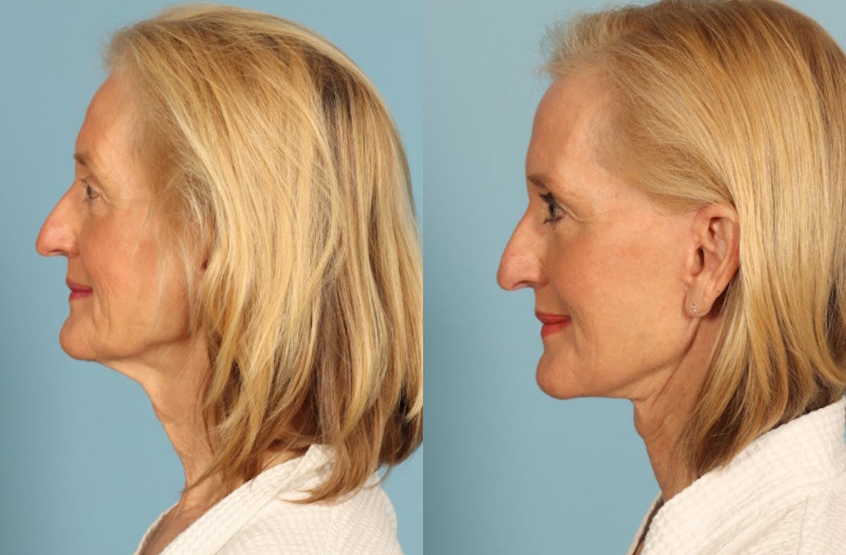Facelift Before & After Gallery - Patient 677302 - Image 4