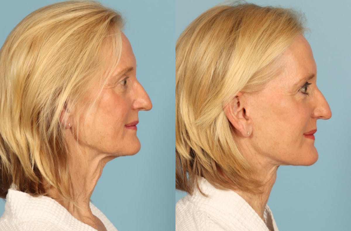 Facelift Before & After Gallery - Patient 677302 - Image 5