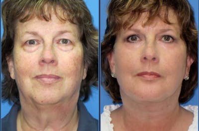 Facelift Before & After Gallery - Patient 226840 - Image 1