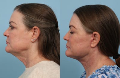 Neck Lift Before & After Gallery - Patient 222630 - Image 1