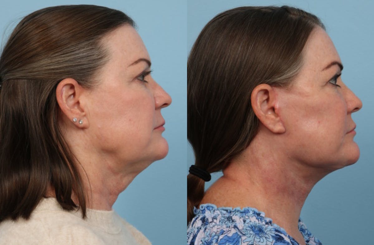 Neck Lift Before & After Gallery - Patient 222630 - Image 2