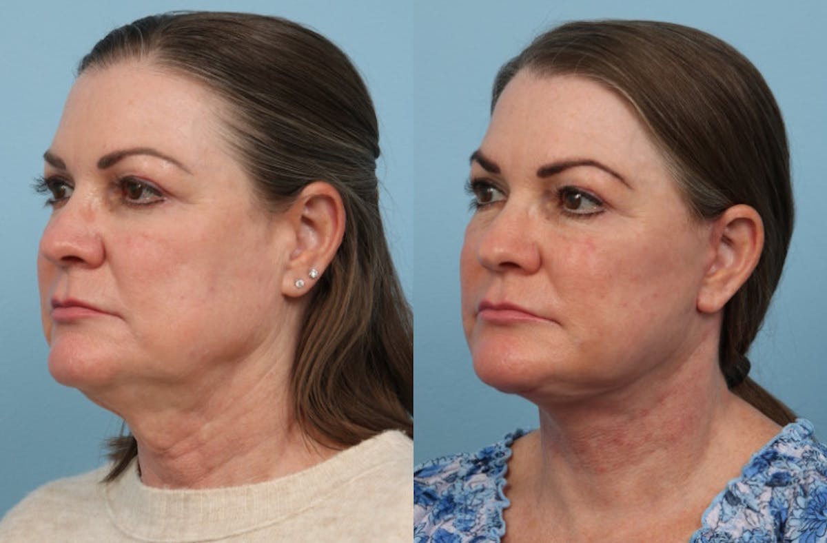 Neck Lift Before & After Gallery - Patient 222630 - Image 3