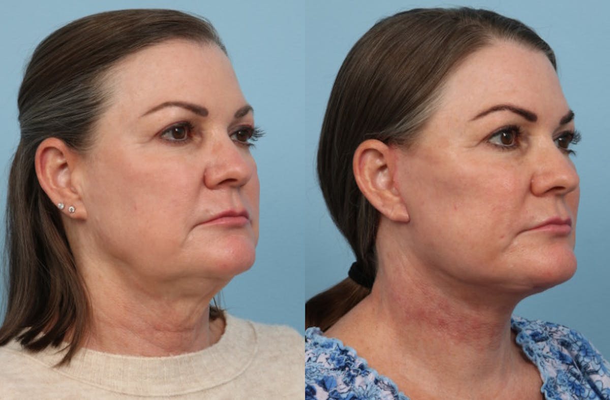 Neck Lift Before & After Gallery - Patient 222630 - Image 4