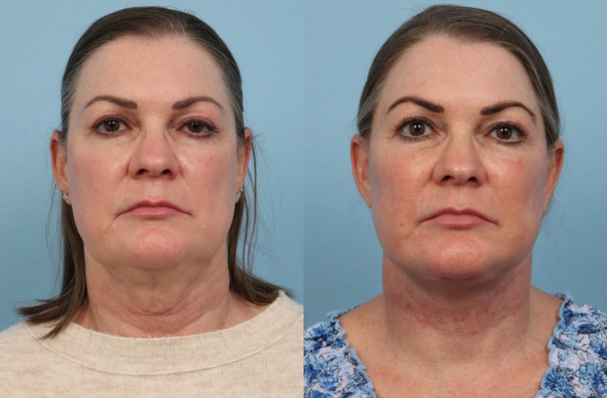 Neck Lift Before & After Gallery - Patient 222630 - Image 5
