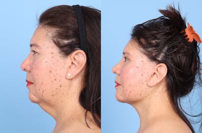 Neck Lift Before & After Gallery - Patient 333202 - Image 1