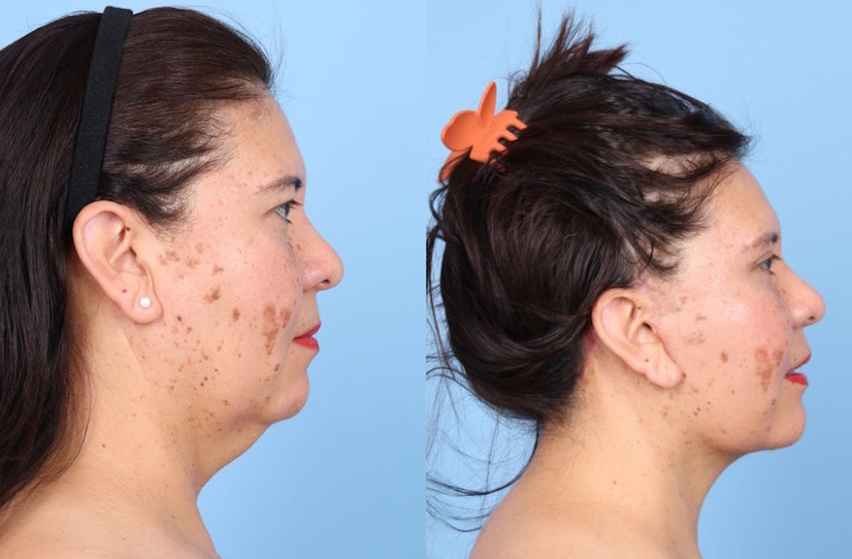 Neck Lift Before & After Gallery - Patient 333202 - Image 2