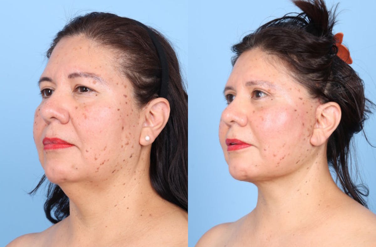 Neck Lift Before & After Gallery - Patient 333202 - Image 3