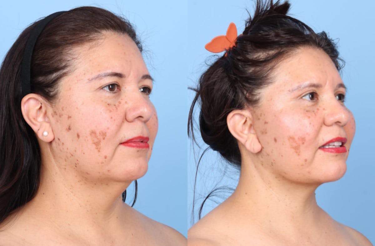 Neck Lift Before & After Gallery - Patient 333202 - Image 4
