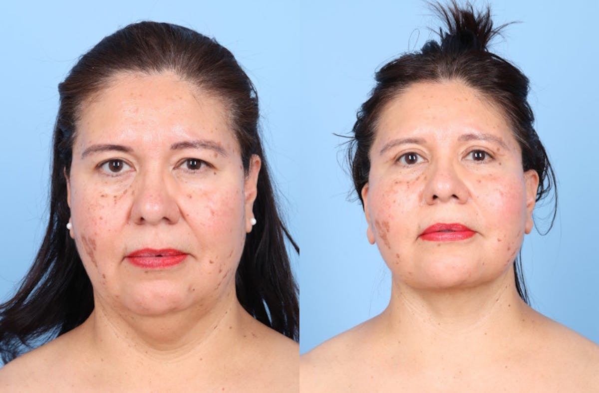 Neck Lift Before & After Gallery - Patient 333202 - Image 5