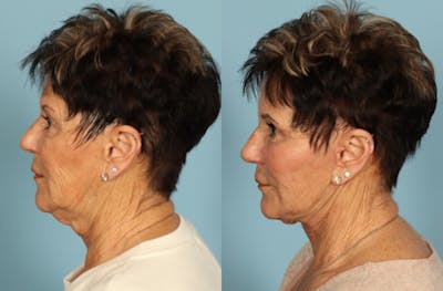 Neck Lift Before & After Gallery - Patient 312283 - Image 1