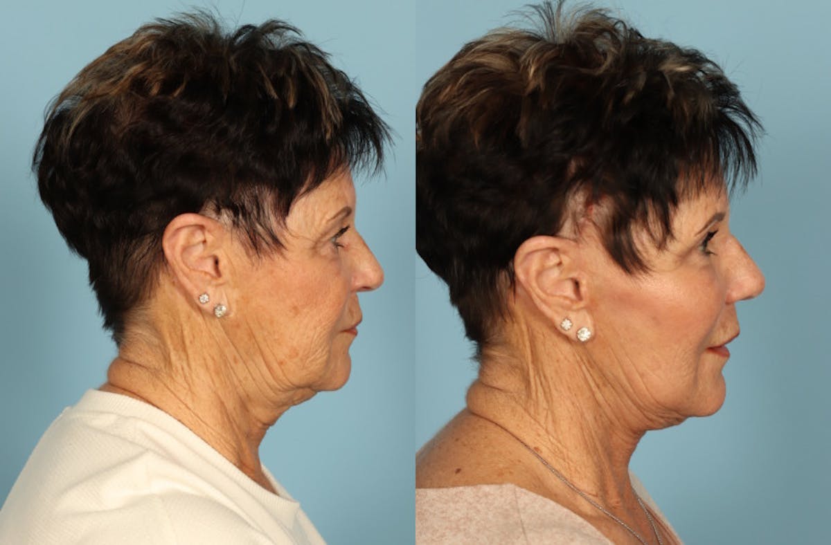 Neck Lift Before & After Gallery - Patient 312283 - Image 2