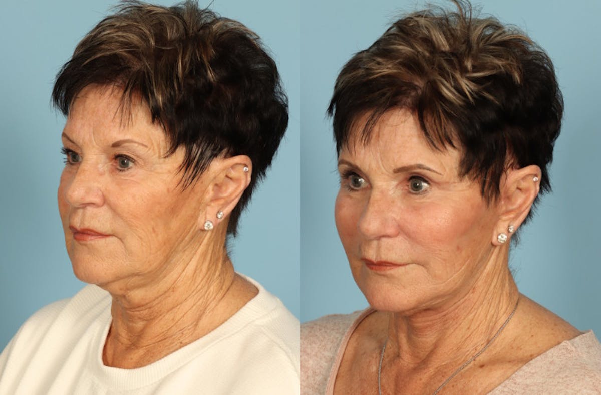 Neck Lift Before & After Gallery - Patient 312283 - Image 3