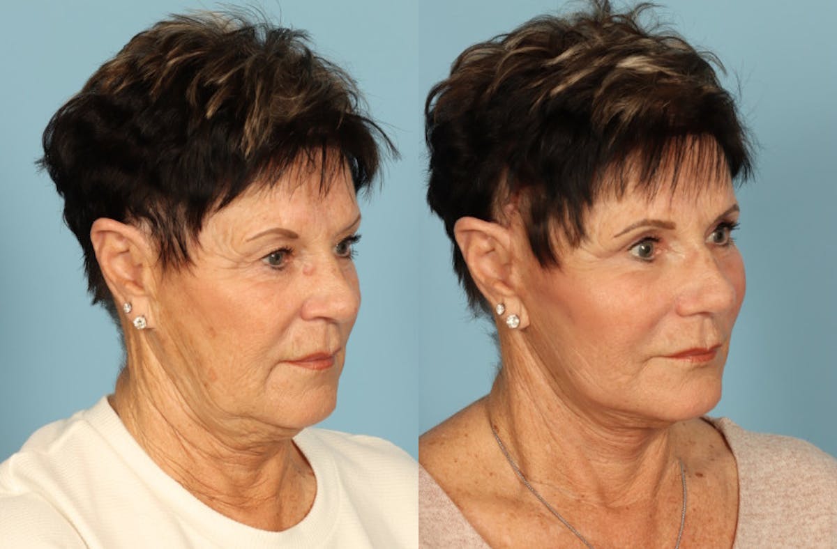 Neck Lift Before & After Gallery - Patient 312283 - Image 4