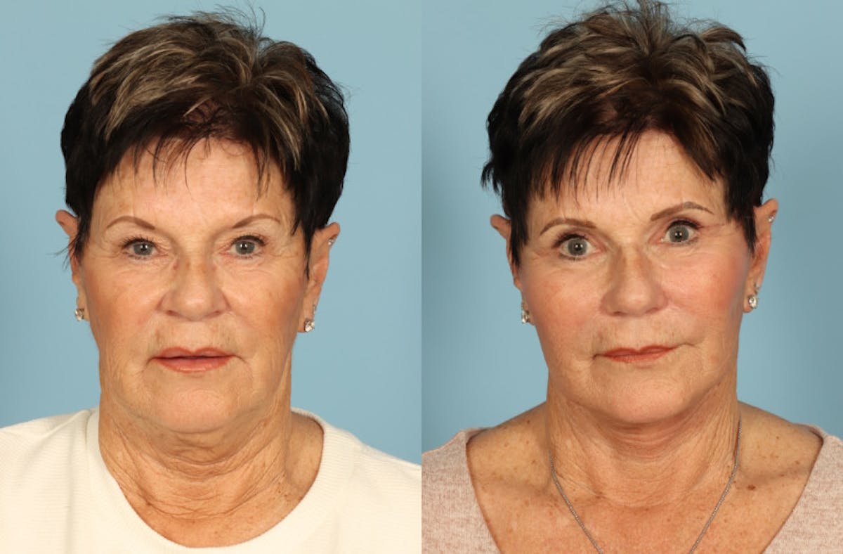 Neck Lift Before & After Gallery - Patient 312283 - Image 5