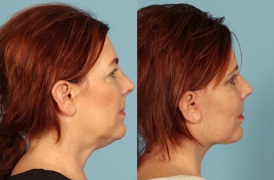 Neck Lift Before & After Gallery - Patient 117229 - Image 1
