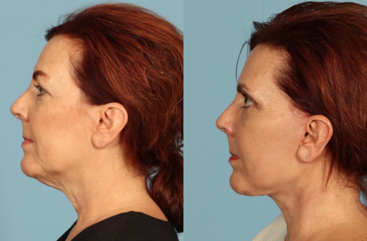 Neck Lift Before & After Gallery - Patient 117229 - Image 2