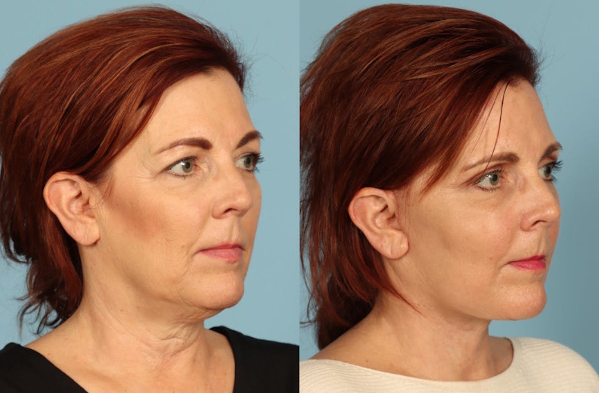 Neck Lift Before & After Gallery - Patient 117229 - Image 3