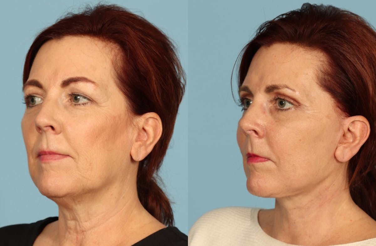 Neck Lift Before & After Gallery - Patient 117229 - Image 4